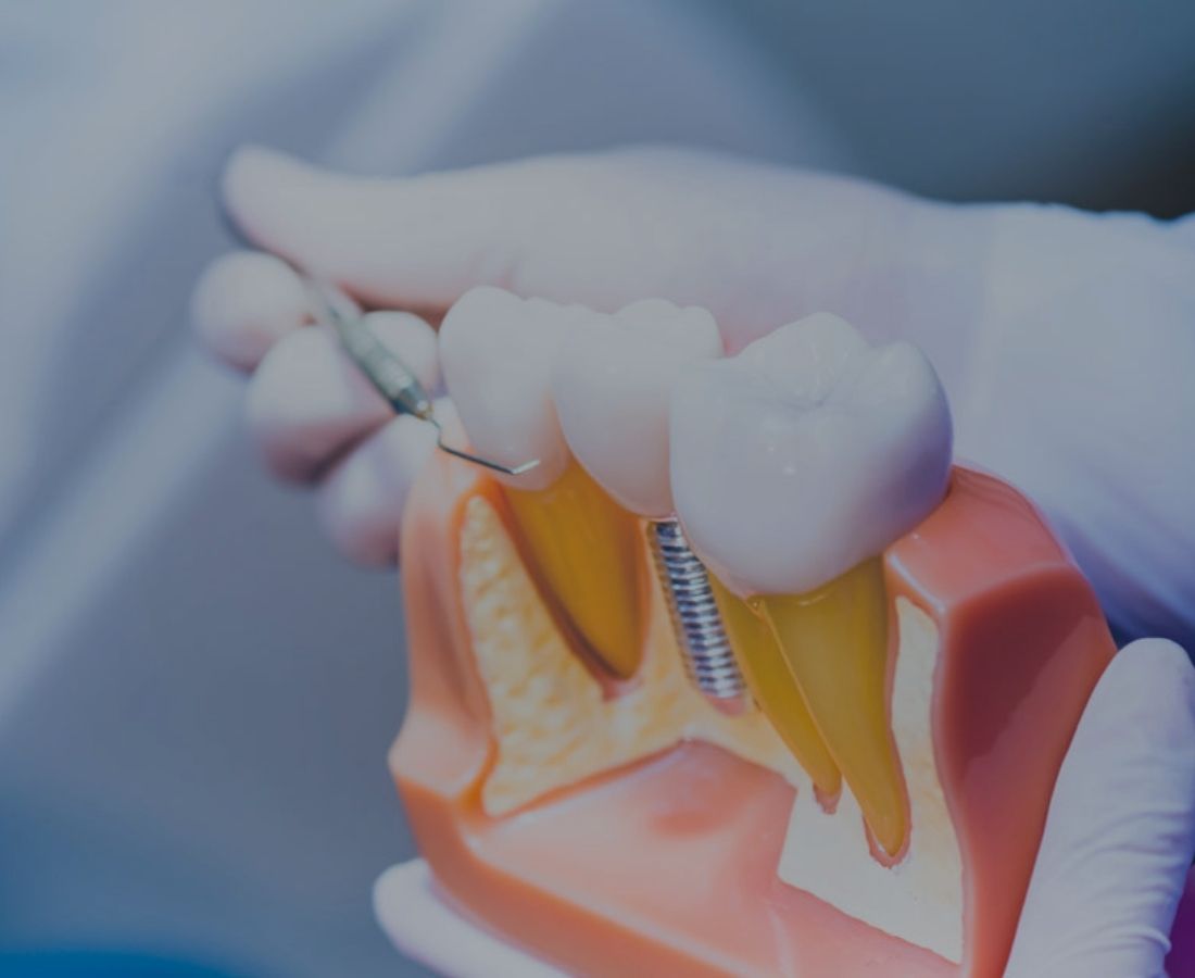 Implantes Dentales en Murcia | Pérez Llanes Clínica Dental
