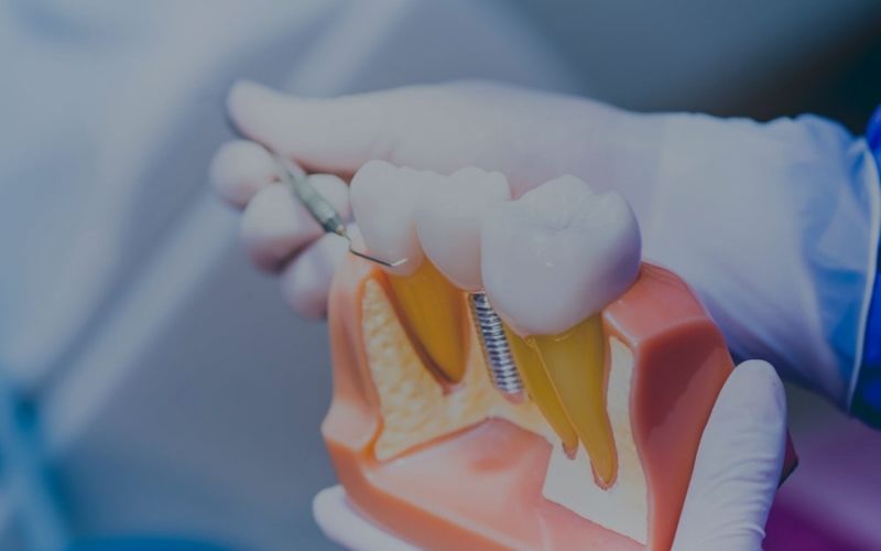 Implantes Dentales en Murcia - Clínica Dental Pérez Llanes