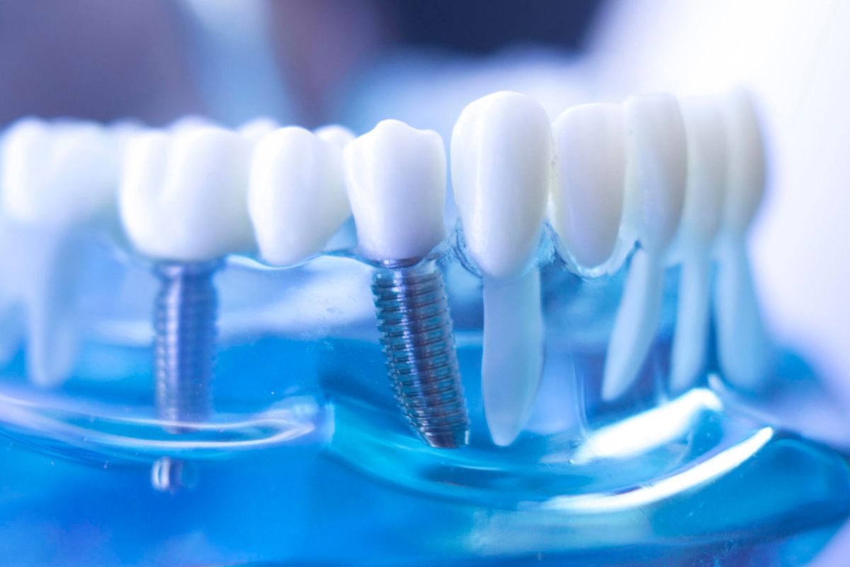 Tipos de Implantes Dentales - Murcia | PÉREZ LLANES CLÍNICA DENTAL